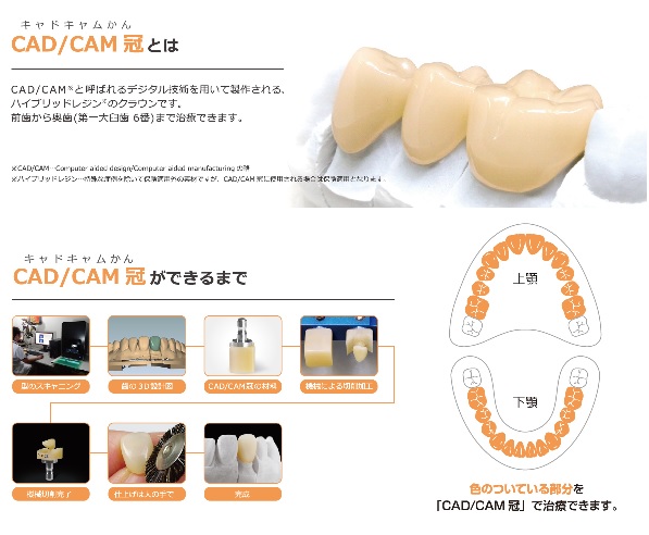CAD・CAM 冠
